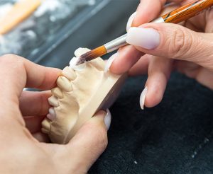 dental bridges