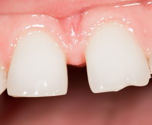 dental bridges