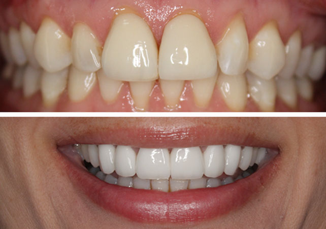 Black Triangle Teeth – How to Fix Black Triangles Between Teeth