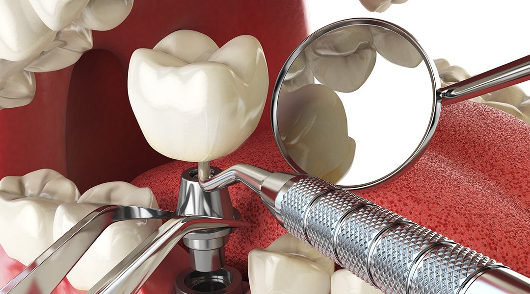 Different Types of Dental Implants