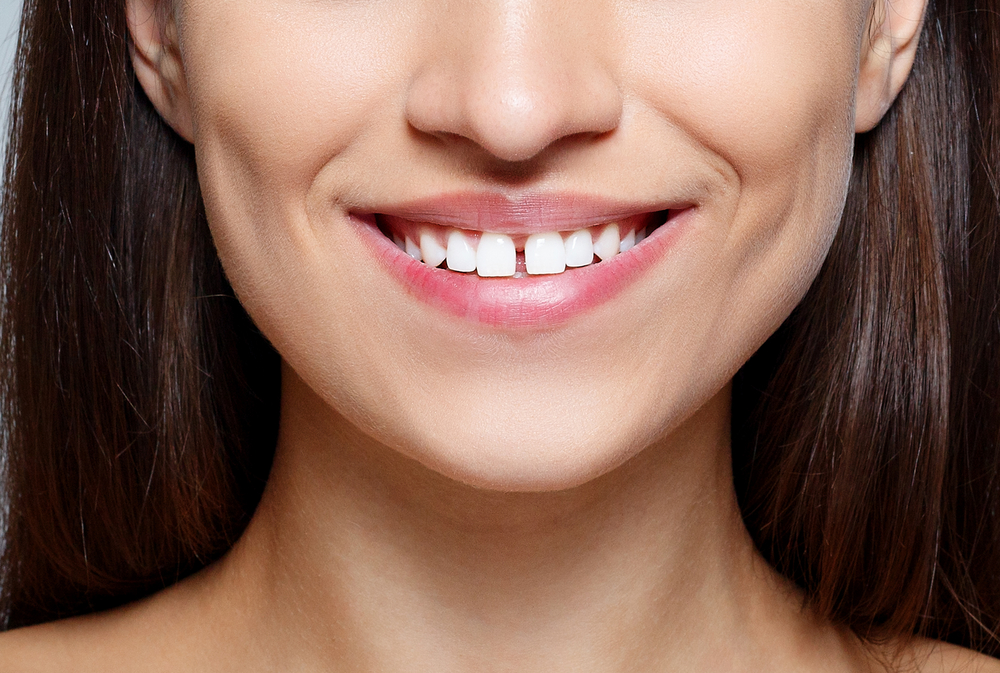 What is Diastema and How to Treat it?