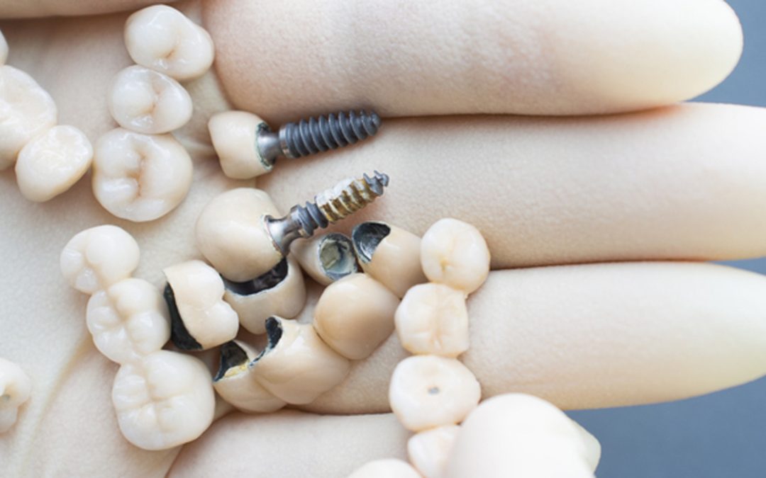 Dental Work And Metal Allergies – Myth or Reality?