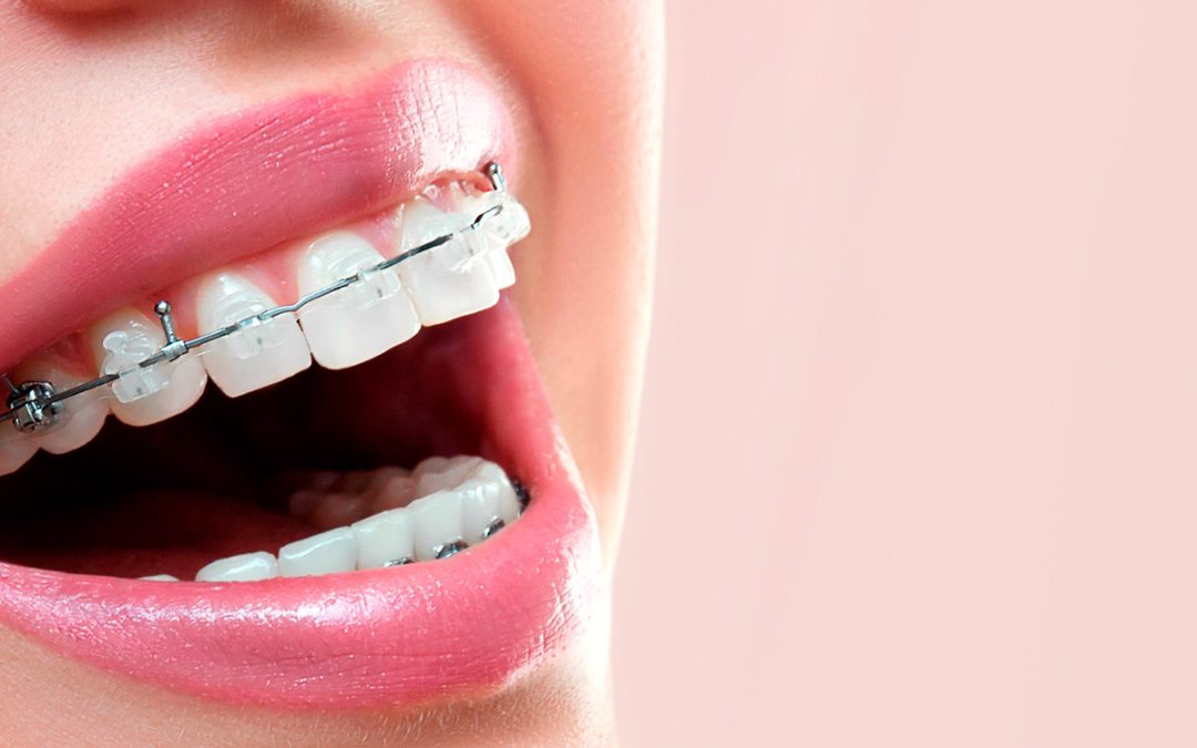 What Are The 5 Types of Braces?
