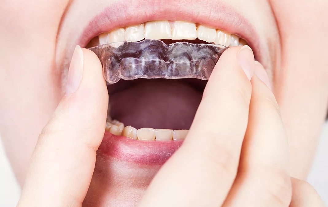 What Are the Benefits of Mouth Guards?