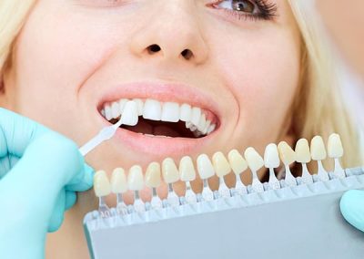 dentist_chapnick_smile_gallery_porcelian_restorations