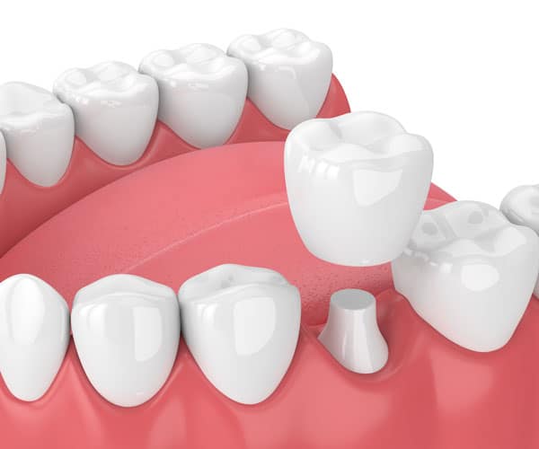 Dental-Crowns-Gallery