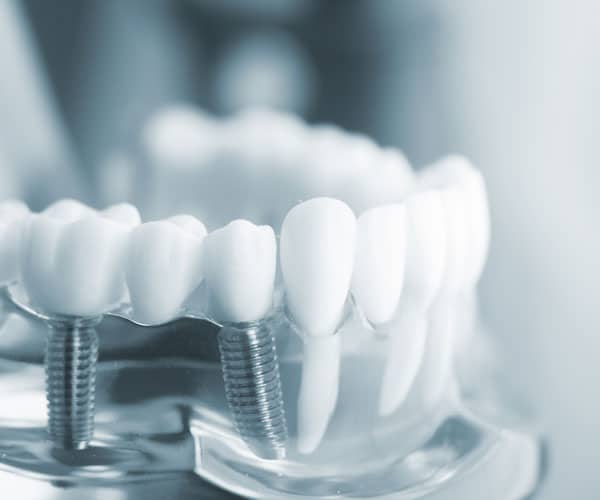 Dental-Implants-Gallery
