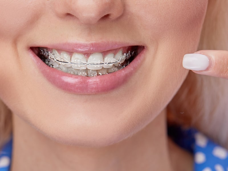 Getting Your Teeth Cleaned While Wearing Braces