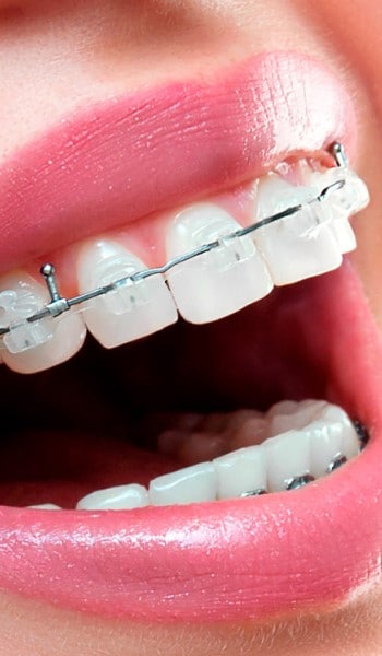 Invisalign-vs-braces-Chapnick-dental-menu